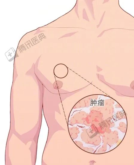 男人很容易忽視的一種癌，確診大多是晚期