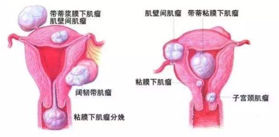 子宮肌瘤不開刀的治療方式——子宮動脈栓塞術