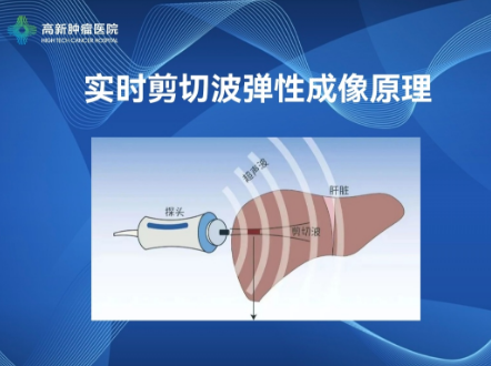 【高新喜報】我院開展肝臟實時剪切波彈性成像檢查技術，肝纖維化、肝硬化可以無創(chuàng)診斷啦！