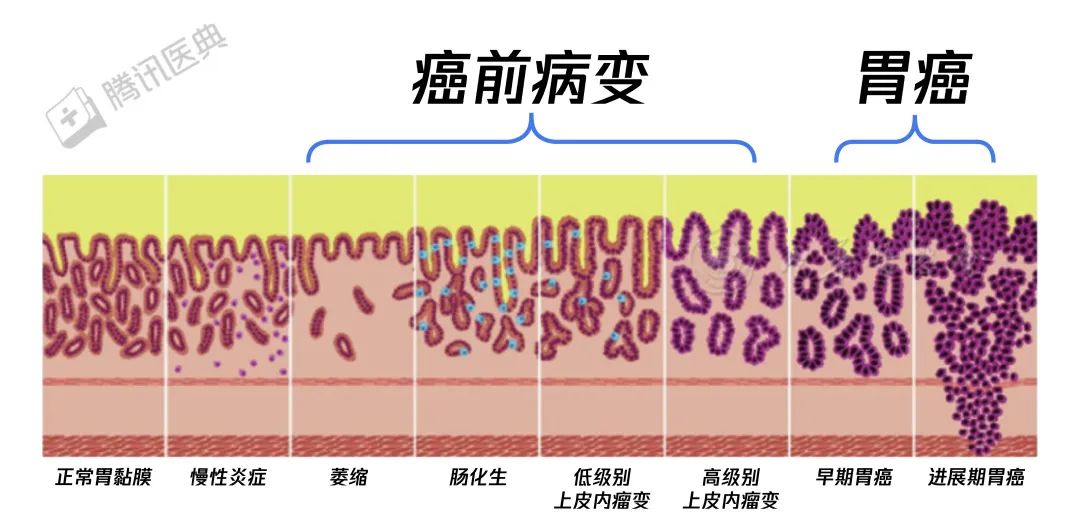 胃癌來臨前，會經歷這個階段！千萬別不當回事